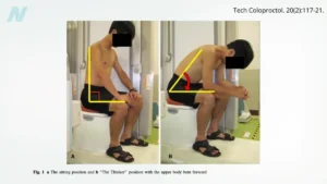 unveiling-the-optimal-posture-the-squatty-potty-put-to-the-test-and-the-broader-bowel-movement-debate