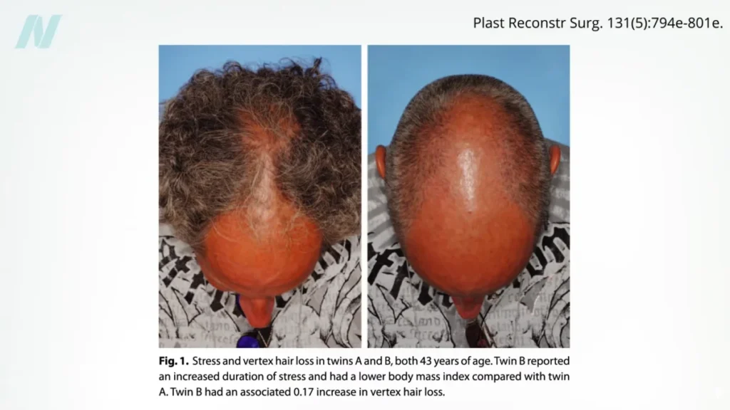 unraveling-the-enigma-of-hair-loss-beyond-genetics-and-myths