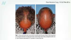 the-unraveling-strand-deconstructing-myths-around-biotin-zinc-and-hair-loss